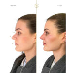 The 20‑Minute Nose Job London Is Quietly Obsessed With