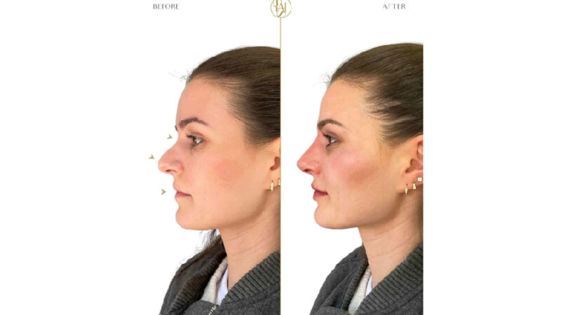 The 20‑Minute Nose Job London Is Quietly Obsessed With