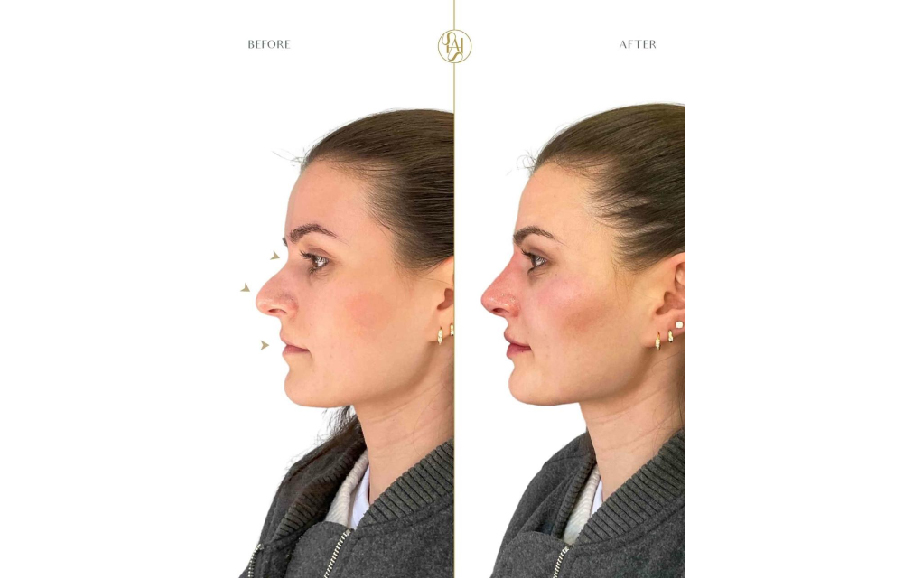 20‑Minute Nose Job London